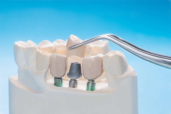 How Easy Is It To Replace An Implant Crown?